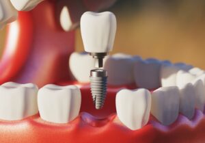 Digital view of a dental implant