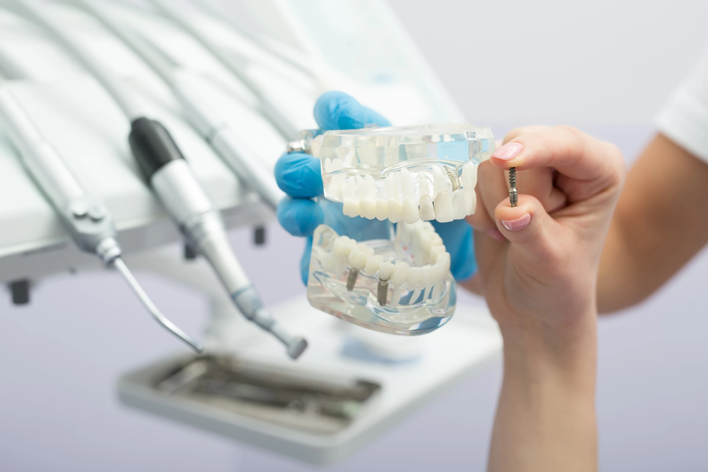 dental implants model