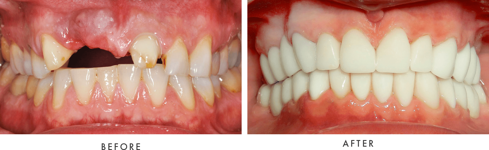 Dental Implants