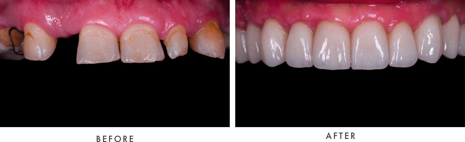 Full Mouth Dental Implants