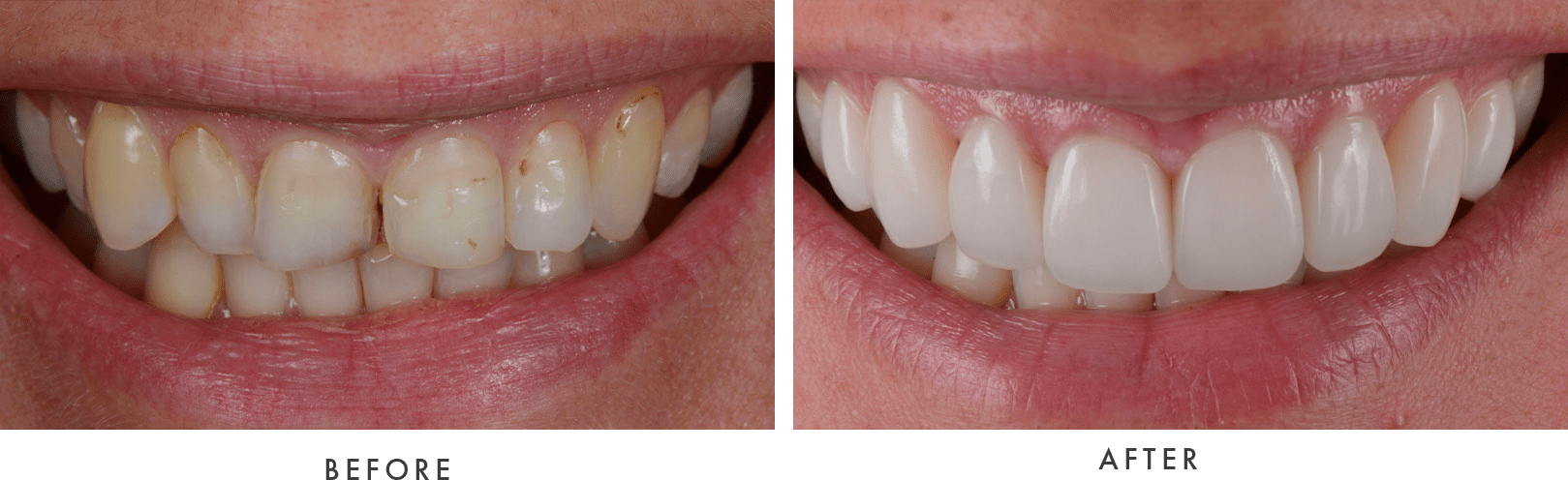 Porcelain Veneers