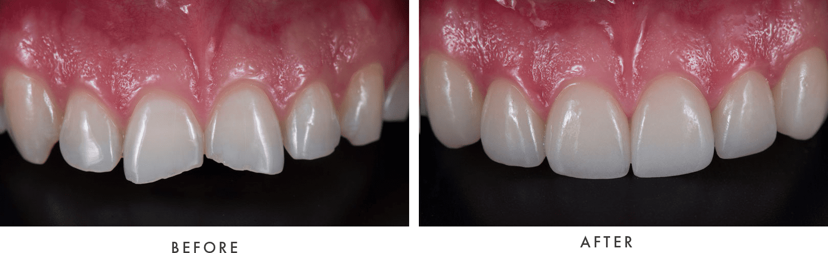 Porcelain Veneers